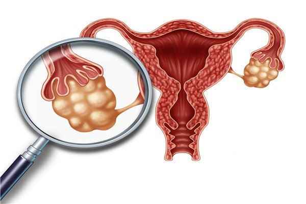 卵巢多囊的表现有哪些？严重吗？